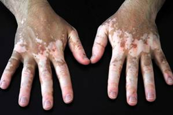 Vitiligo tedavisinde umut ışığı