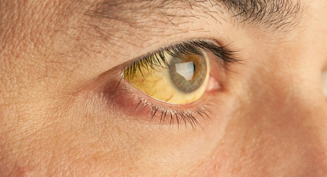 Hepatit virüsü 2015'te 1,34 milyon can aldı