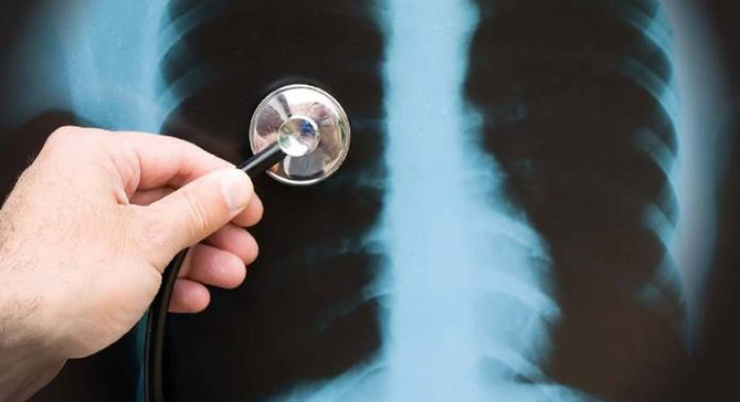 Türkiye'de veremle mücadelede başarı yüzde 90
