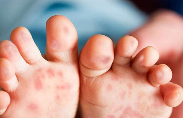 El Ayak Hastaligi Kasinti