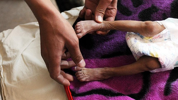 ICRC Sözcüsü Zevkari: Milyonlarca Yemenli aç uyuyor